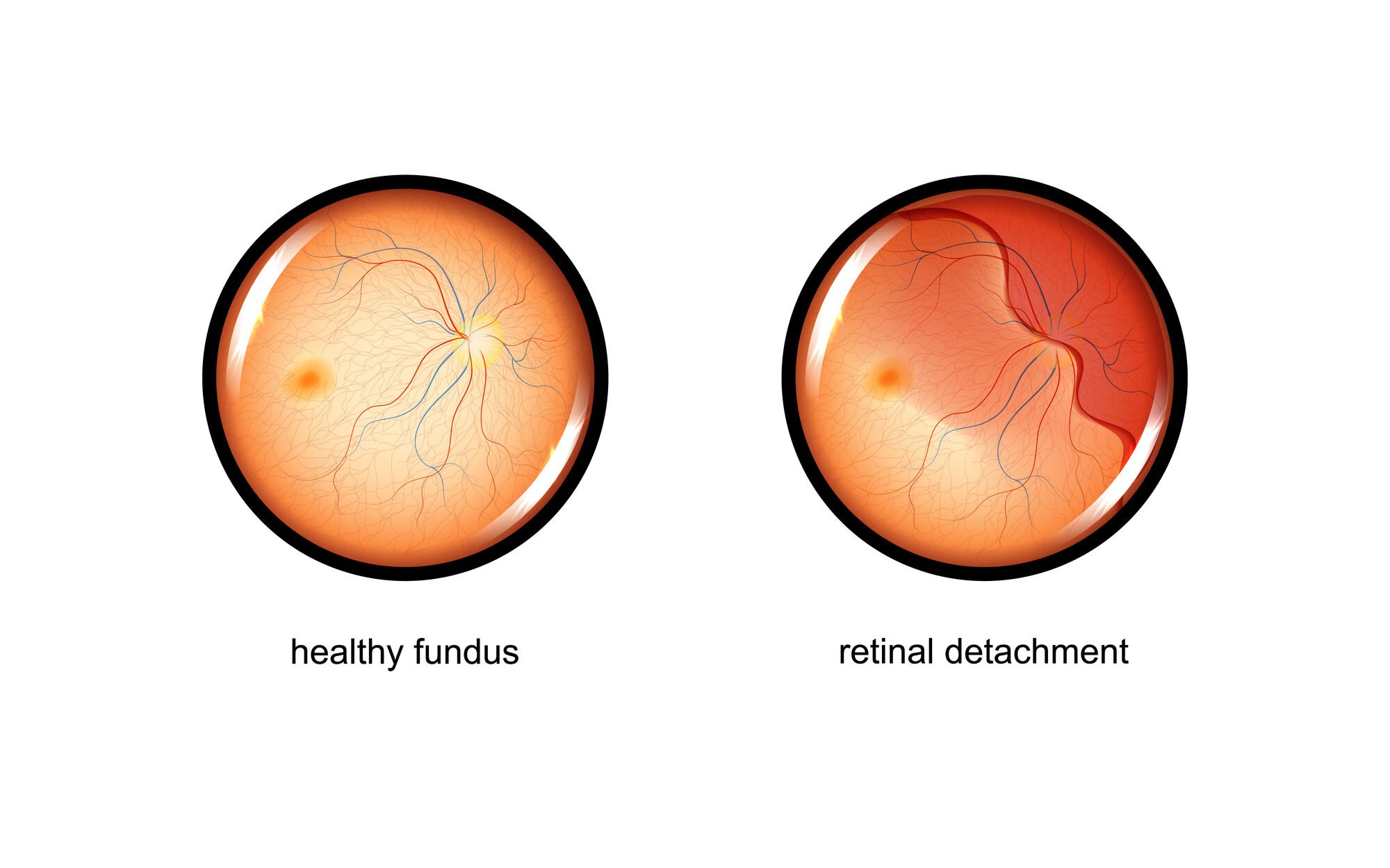 retinal detachment 1 edited