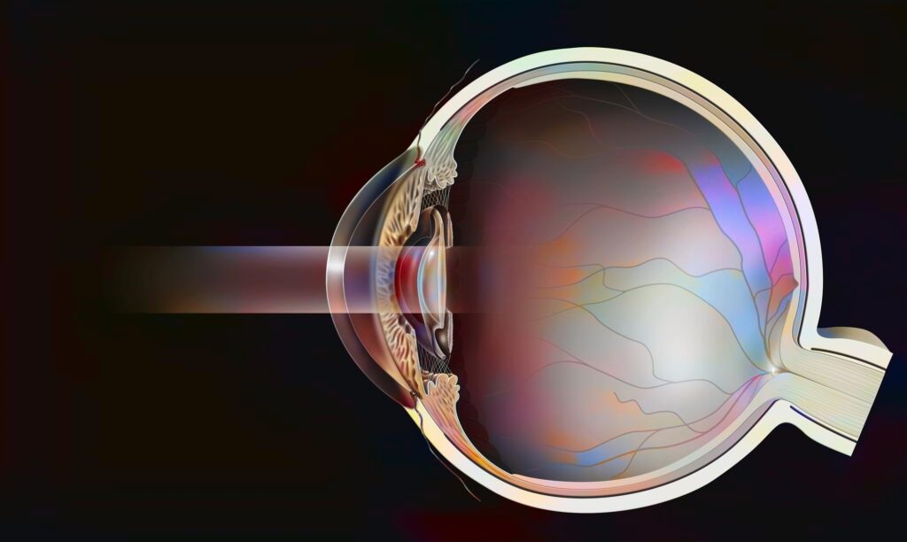 Sectional eye with secondary cataract treated with YAG laser