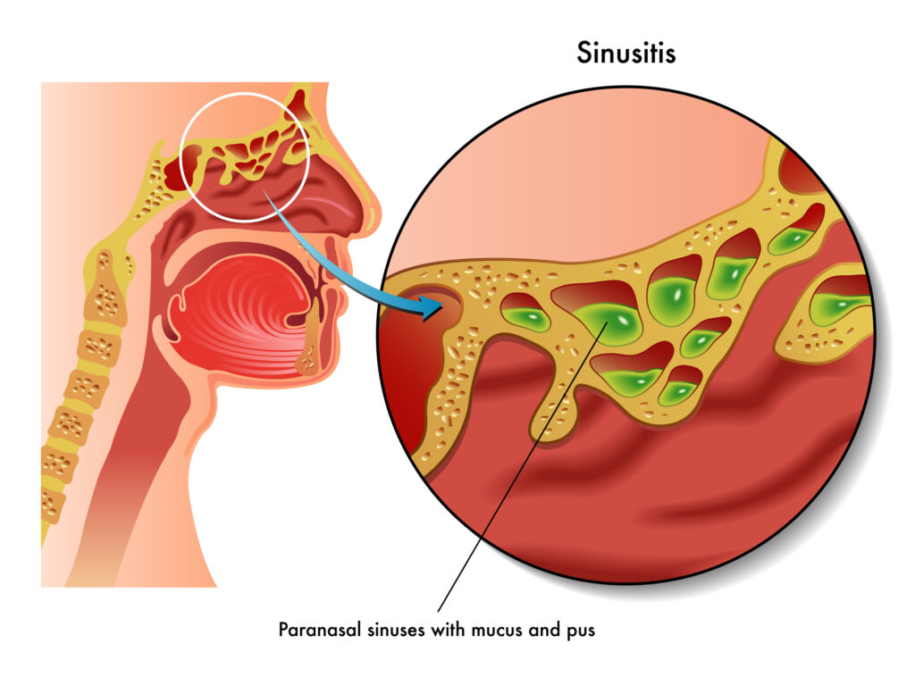 Sinusitis vector