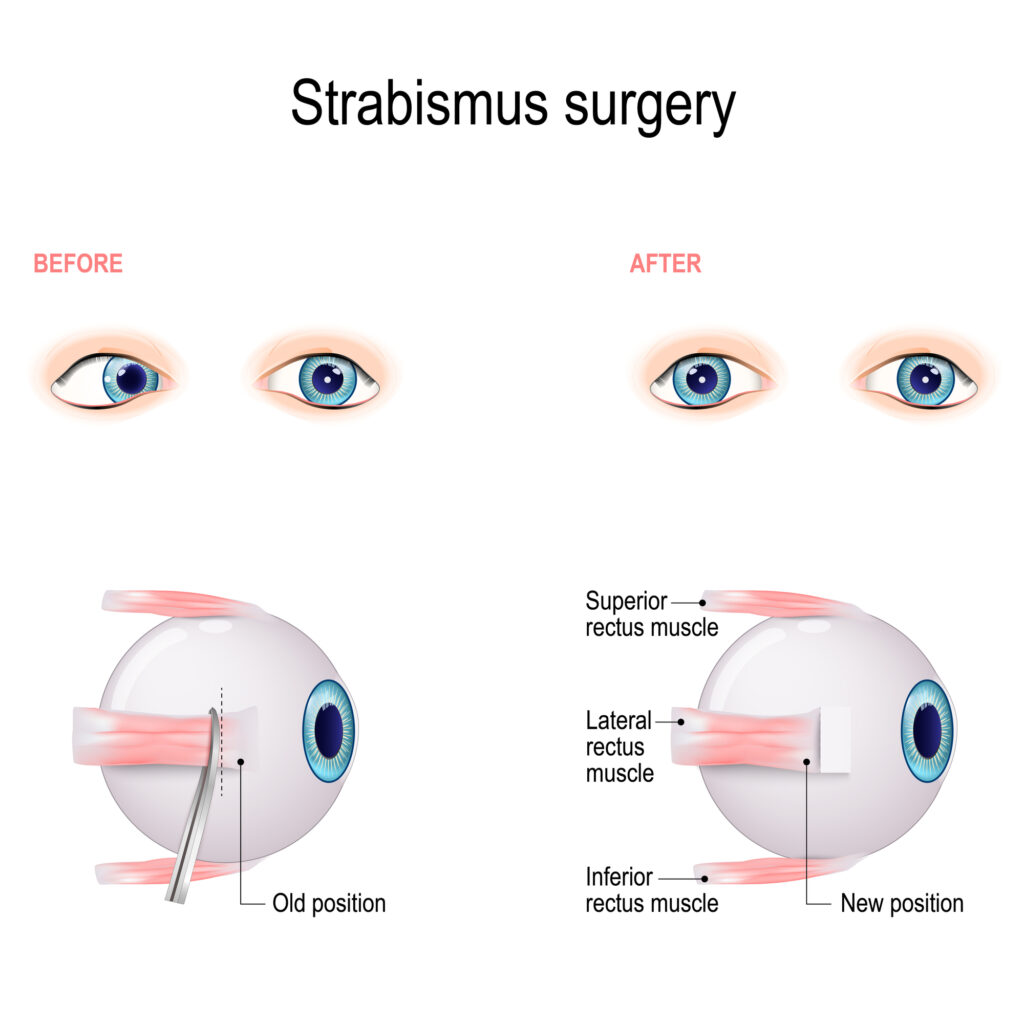 Strabismus surgery illustration