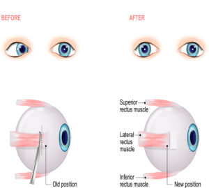 Strabismus Surgery