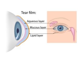 What Is Dry Eye Syndrome?