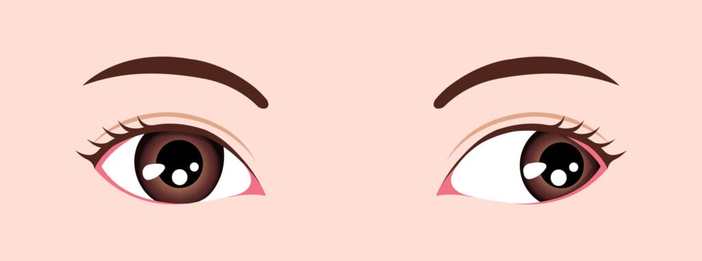 Type of strabismus vector illustration Exotropia