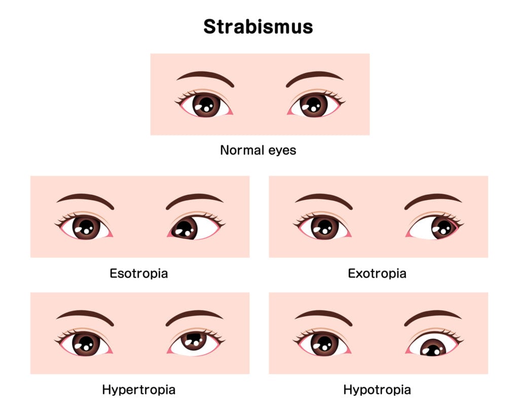 Types of strabismus vector illustration