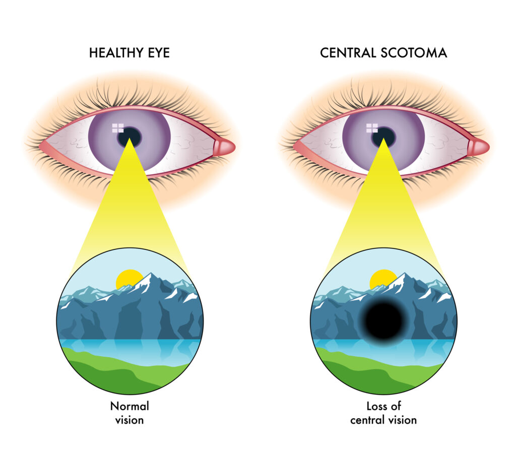 Vector illustration of central scotoma