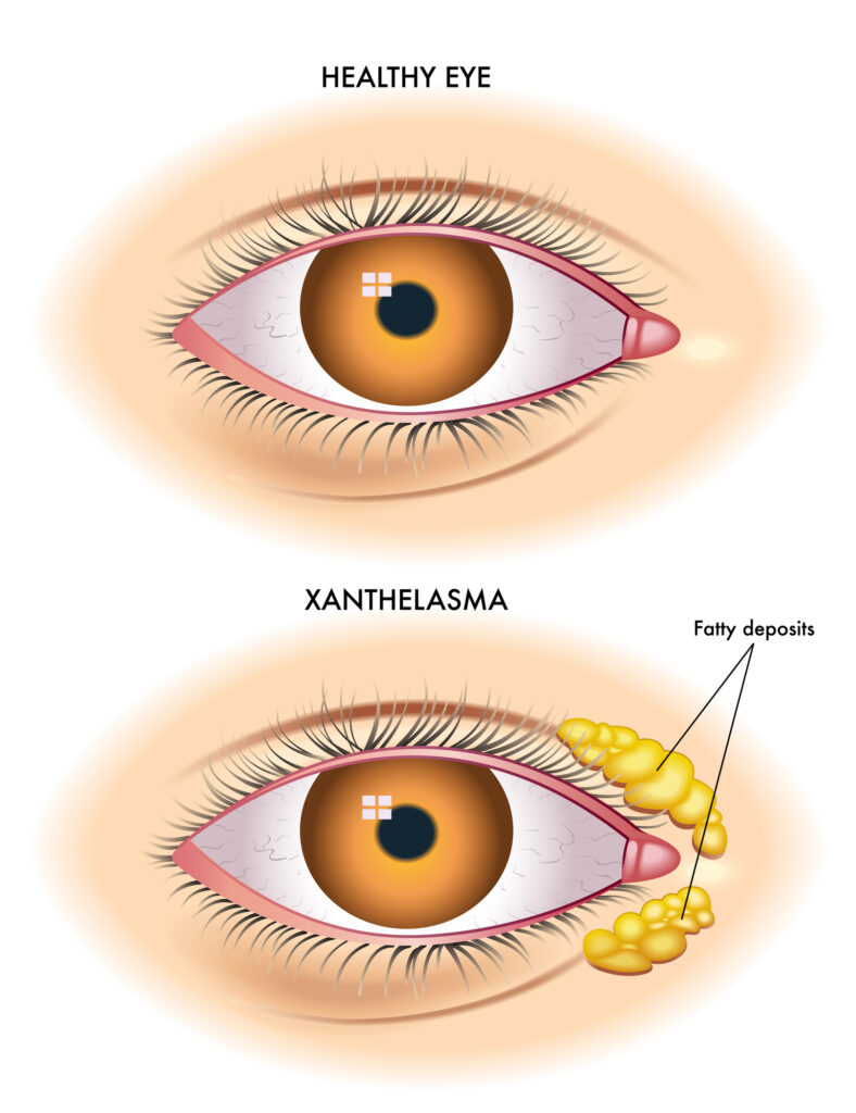 Vector illustration of xanthelasma versus a healthy eye