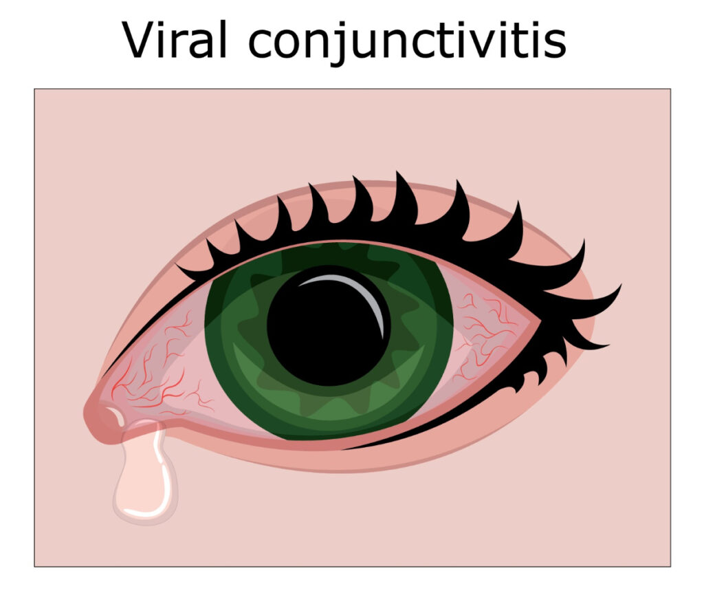 viral conjunctivitis 1