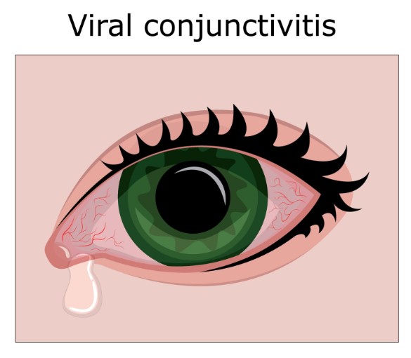 viral conjunctivitis