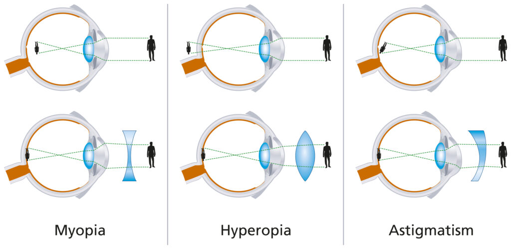 Vision Defects Myopia Hyperopia And Astigmatism Illustrations