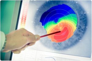 Wavefront Aberrometry