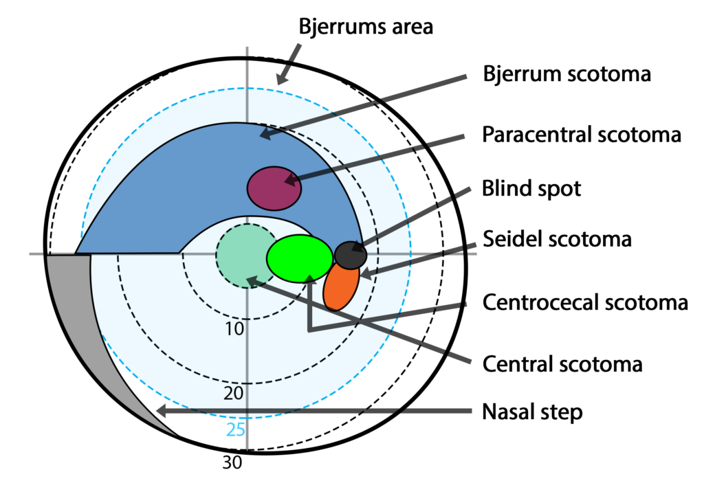 Bjerrums area and types of scotomas on the visual field