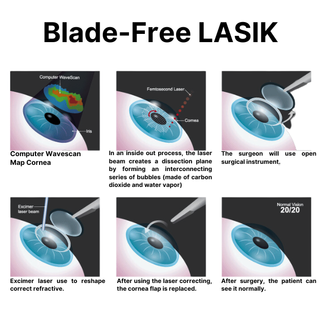 Bladeless Blade Free LASIK illustration Vision Center