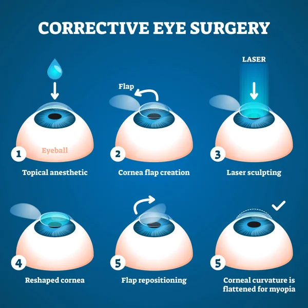 Corrective eye surgery