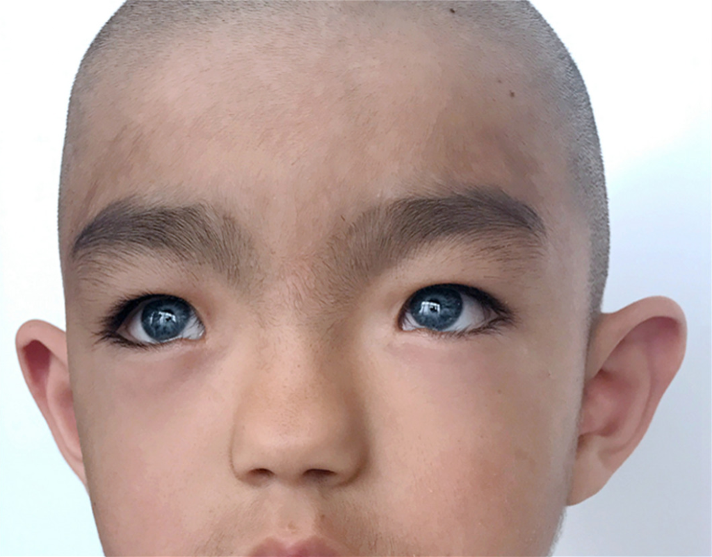 Facial appearance of a boy from China with Waardenburg syndrome type 1