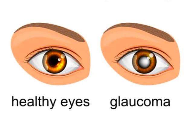 Glaucoma Vector