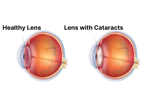 Healthy lens vs lens with cataracts illustration edited