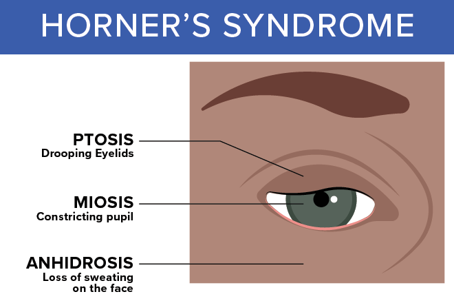 Horners syndrome