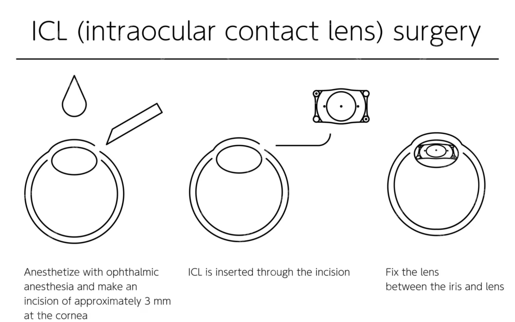 ICL or Intraocular Contact Lens Surgery Illustrateion