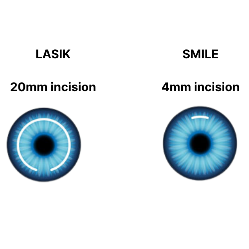 LASIK vs SMILE procedure illustration