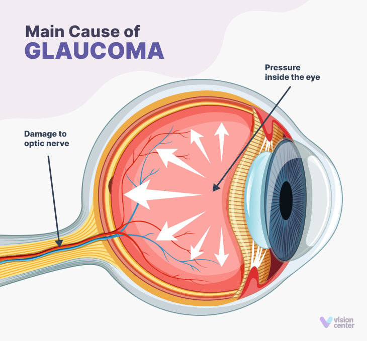 main cause of glaucoma