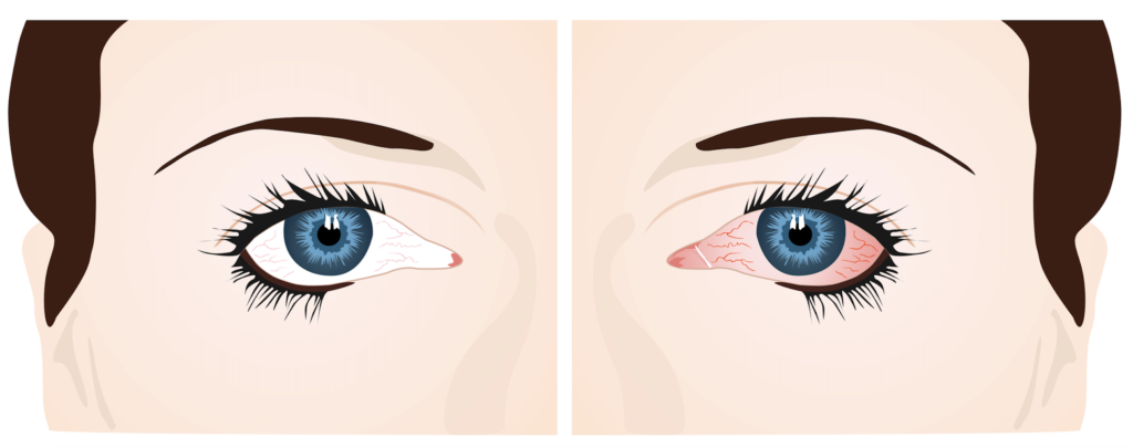 Normal eye vs Burning Eye