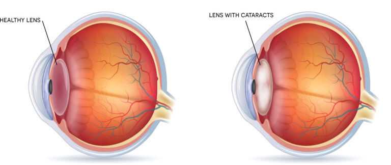 How cataracts develops - Healthy Eye vs Eye with Cataract