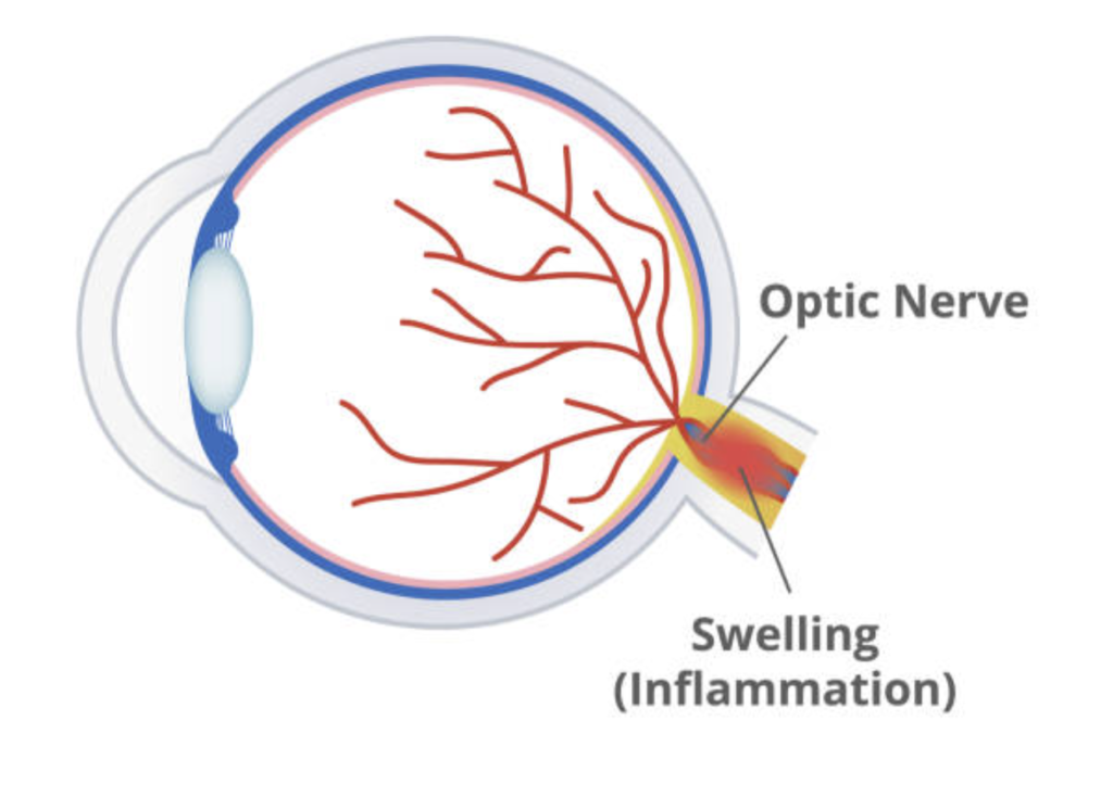 Optic Neuritis illustration