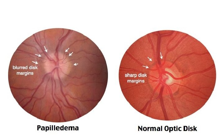 Papilledema vs. Normal Optic Disk edited