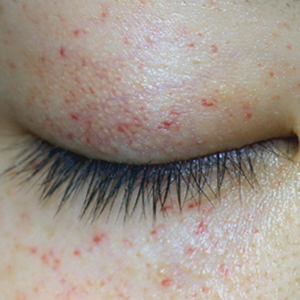 Red Dots Around Eyes (Petechiae)