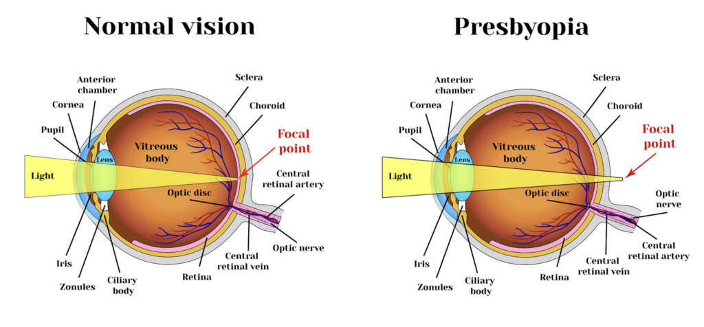 Presbyopia illustration