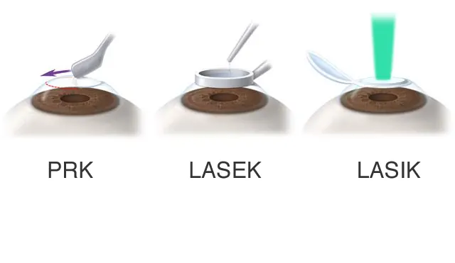 PRK vs LASEK vs LASIK