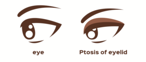 Droopy Eyelids (Ptosis)