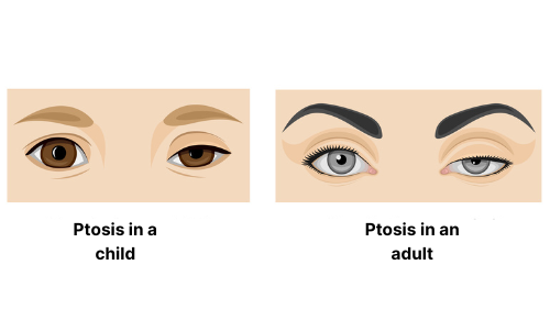 ptosis symptoms edited