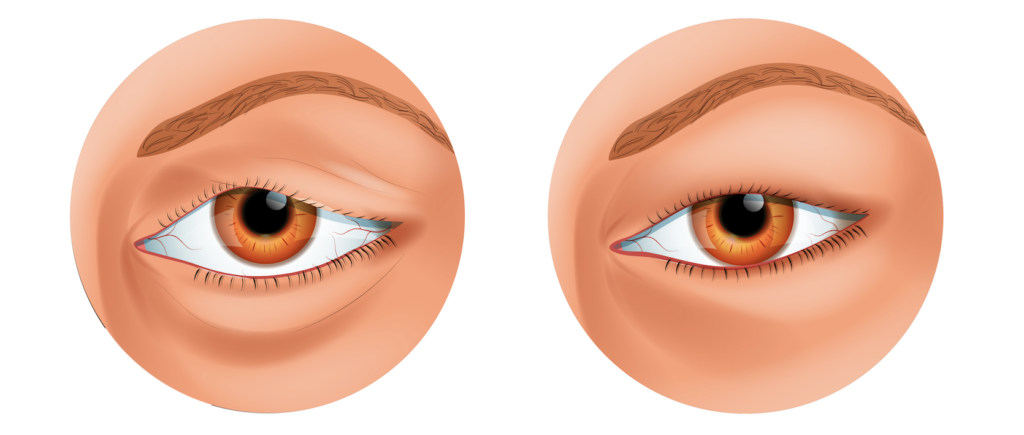 Swollen eyelid medical illustration