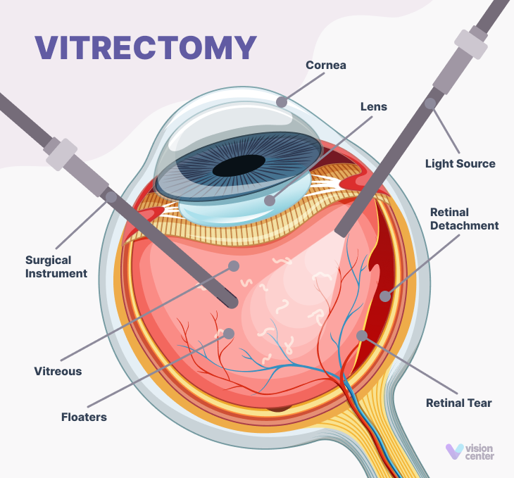 vitrectomy infographic